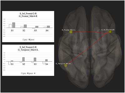 Increased interhemispheric functional connectivity after right anodal tDCS in chronic non-fluent aphasia: preliminary findings